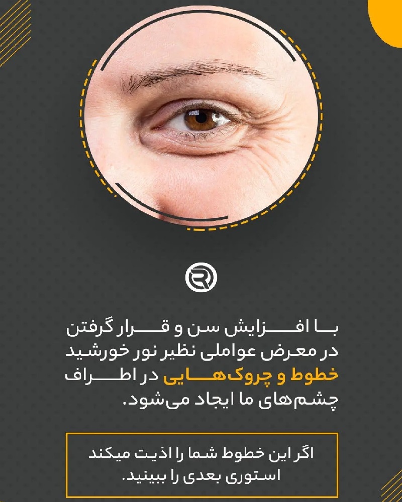 بهترین کولتک اصفهان | بهترین کلینیک لاغری اصفهان | بهترین کلینیک زیبایی اصفهان | درمان خطوط و چروک های اطراف چشم با تزریق مزوژل