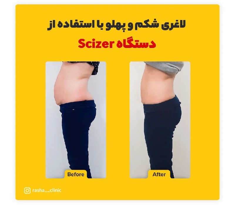 بهترین کولتک اصفهان | بهترین کلینیک لاغری اصفهان | بهترین کلینیک زیبایی اصفهان | لاغری شکم و پهلو با استفاده از دستگاه scizer