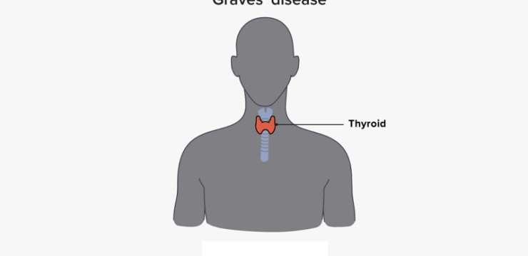 روش های درمان بیماری گریوز | بهترین کلینیک زیبایی اصفهان | کلینیک راشا